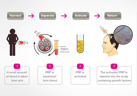 PRP Skin Rejuvenation Dubai